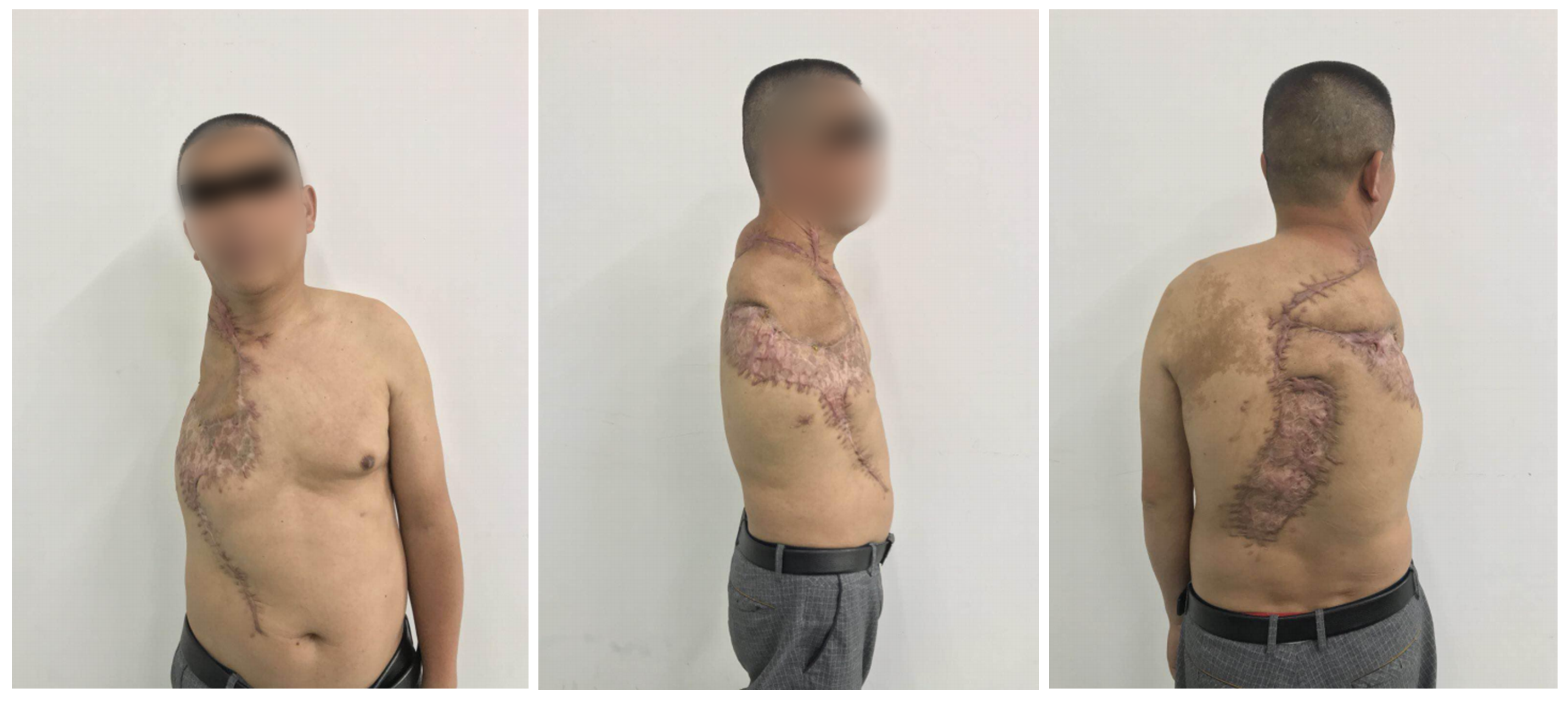 Combined Pedicled Trapezius Flap With Negative Pressure Wound Therapy for Treating a Traumatic